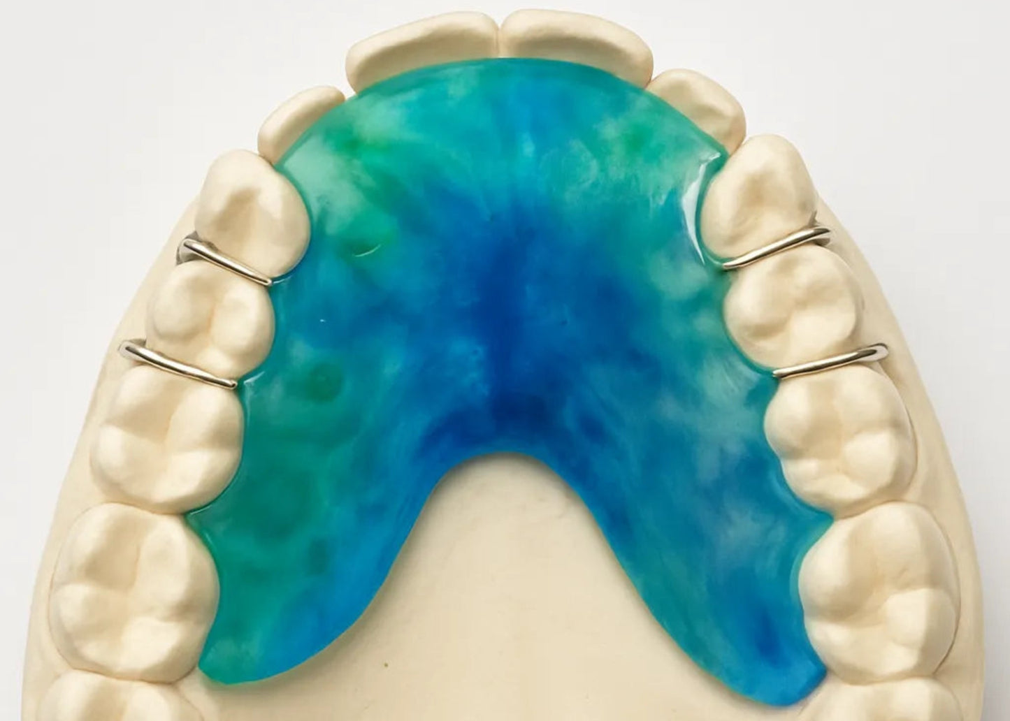 Dental model with blue tie dye upper retainer 